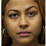 Aesthetic Facial Balancing Before & After Patient #1134