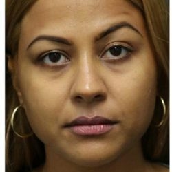 Aesthetic Facial Balancing Before & After Patient #1134