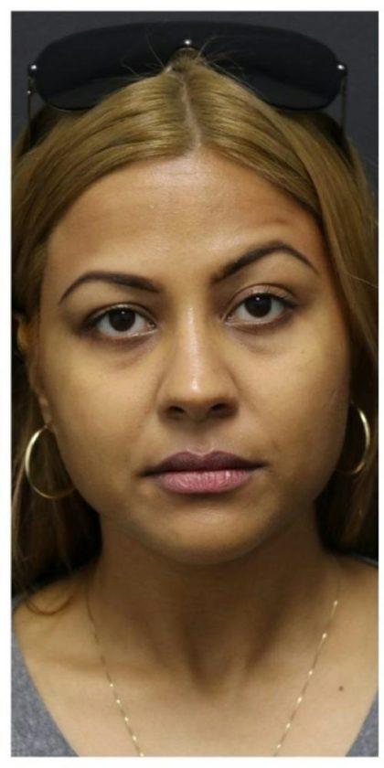 Aesthetic Facial Balancing Before & After Patient #1134