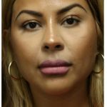 Aesthetic Facial Balancing Before & After Patient #1134