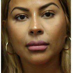 Aesthetic Facial Balancing Before & After Patient #1134