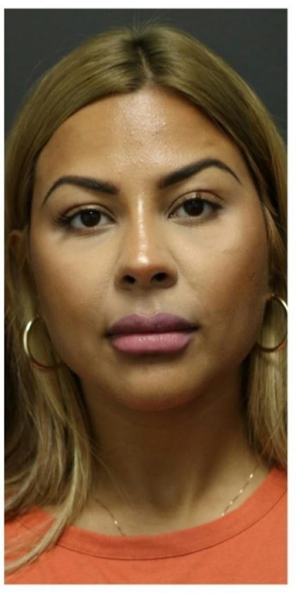 Aesthetic Facial Balancing Before & After Patient #1134