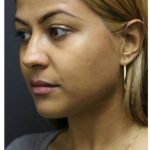 Aesthetic Facial Balancing Before & After Patient #1134