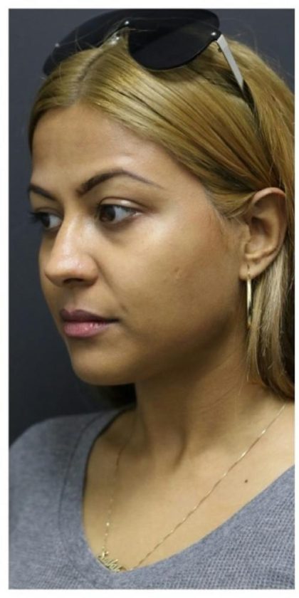 Aesthetic Facial Balancing Before & After Patient #1134