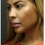 Aesthetic Facial Balancing Before & After Patient #1134