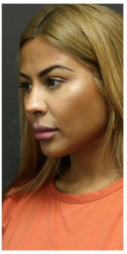 Aesthetic Facial Balancing Before & After Patient #1134