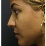 Aesthetic Facial Balancing Before & After Patient #1134