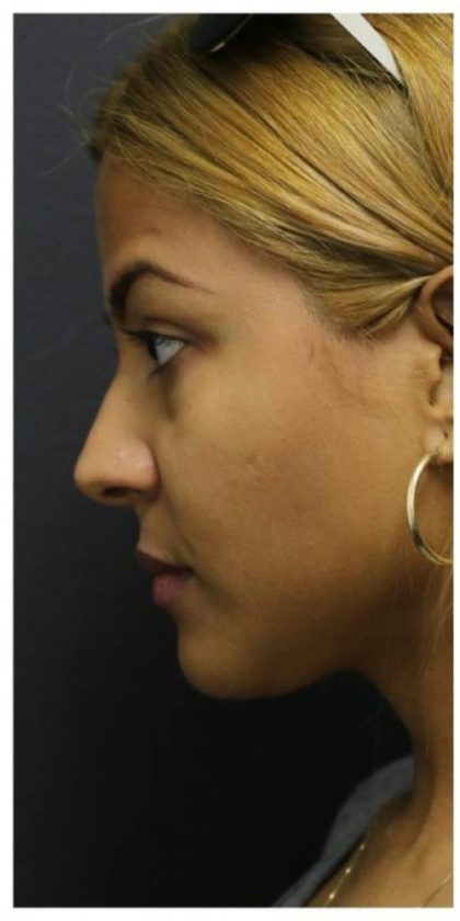 Aesthetic Facial Balancing Before & After Patient #1134