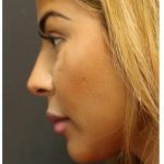 Aesthetic Facial Balancing Before & After Patient #1134