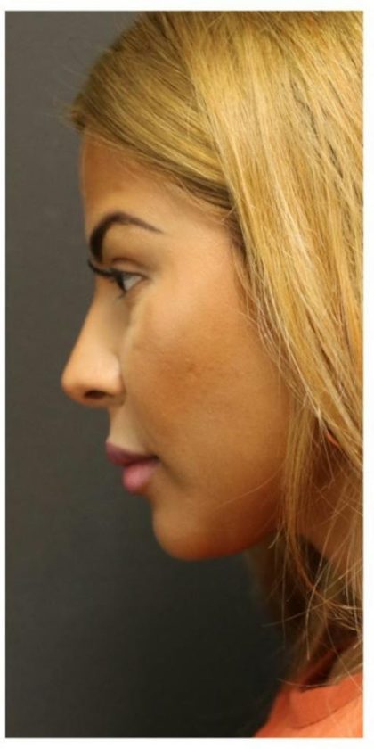 Aesthetic Facial Balancing Before & After Patient #1134