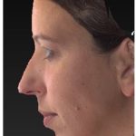 Aesthetic Facial Balancing Before & After Patient #1133