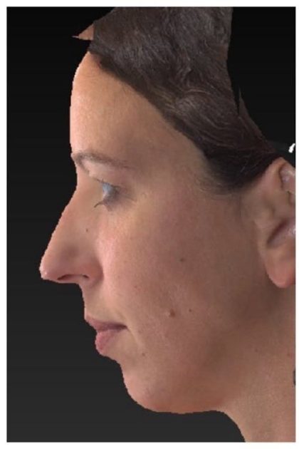 Aesthetic Facial Balancing Before & After Patient #1133