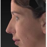 Aesthetic Facial Balancing Before & After Patient #1133