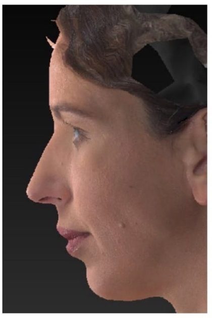 Aesthetic Facial Balancing Before & After Patient #1133