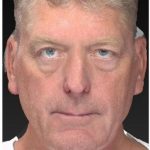 Aesthetic Facial Balancing Before & After Patient #1132