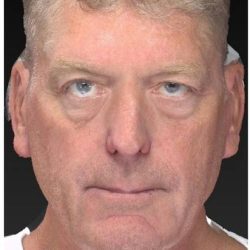 Aesthetic Facial Balancing Before & After Patient #1132