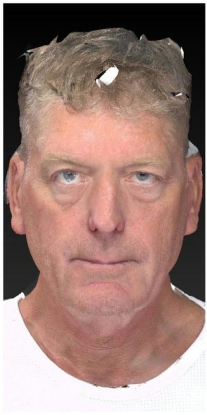Aesthetic Facial Balancing Before & After Patient #1132