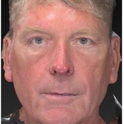 Aesthetic Facial Balancing Before & After Patient #1132