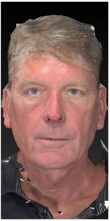 Aesthetic Facial Balancing Before & After Patient #1132