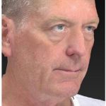 Aesthetic Facial Balancing Before & After Patient #1132