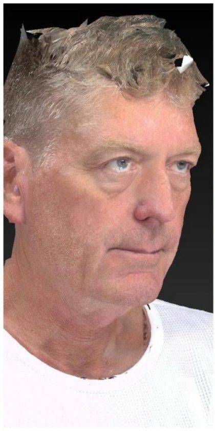 Aesthetic Facial Balancing Before & After Patient #1132