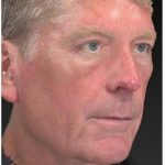 Aesthetic Facial Balancing Before & After Patient #1132