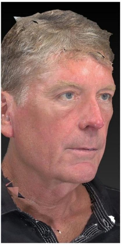 Aesthetic Facial Balancing Before & After Patient #1132