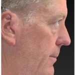Aesthetic Facial Balancing Before & After Patient #1132
