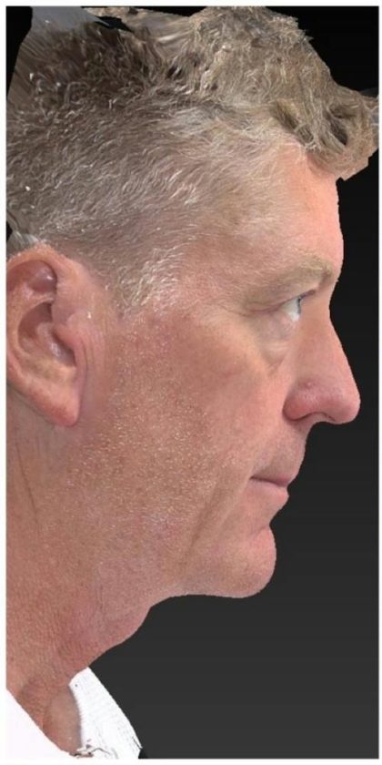 Aesthetic Facial Balancing Before & After Patient #1132