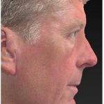 Aesthetic Facial Balancing Before & After Patient #1132
