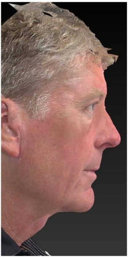 Aesthetic Facial Balancing Before & After Patient #1132