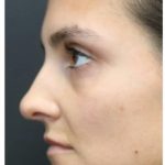 Aesthetic Facial Balancing Before & After Patient #1131