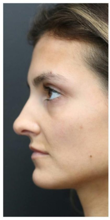 Aesthetic Facial Balancing Before & After Patient #1131