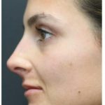 Aesthetic Facial Balancing Before & After Patient #1131