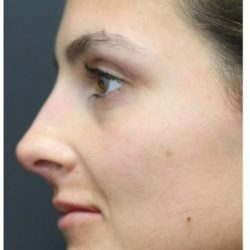 Aesthetic Facial Balancing Before & After Patient #1131