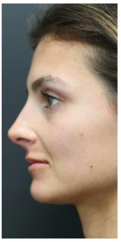 Aesthetic Facial Balancing Before & After Patient #1131