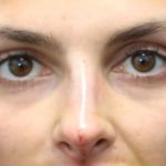 Aesthetic Facial Balancing Before & After Patient #1131