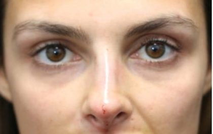 Aesthetic Facial Balancing Before & After Patient #1131