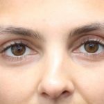 Aesthetic Facial Balancing Before & After Patient #1131