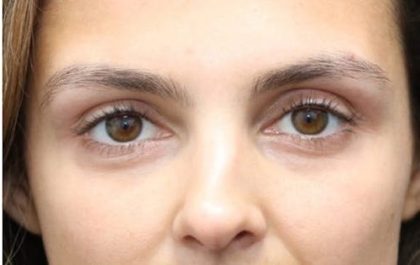 Aesthetic Facial Balancing Before & After Patient #1131