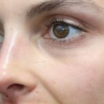 Aesthetic Facial Balancing Before & After Patient #1131