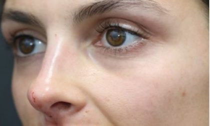Aesthetic Facial Balancing Before & After Patient #1131