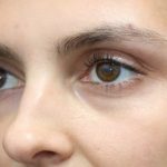Aesthetic Facial Balancing Before & After Patient #1131