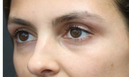 Aesthetic Facial Balancing Before & After Patient #1131