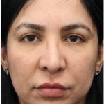 Aesthetic Facial Balancing Before & After Patient #1130