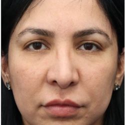 Aesthetic Facial Balancing Before & After Patient #1130