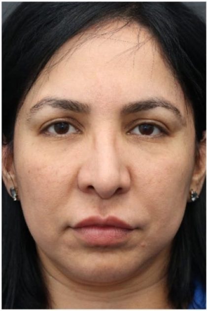 Aesthetic Facial Balancing Before & After Patient #1130