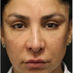 Aesthetic Facial Balancing Before & After Patient #1130