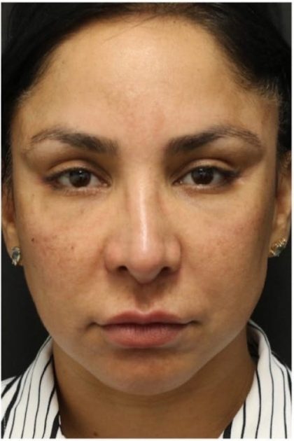 Aesthetic Facial Balancing Before & After Patient #1130