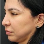 Aesthetic Facial Balancing Before & After Patient #1130